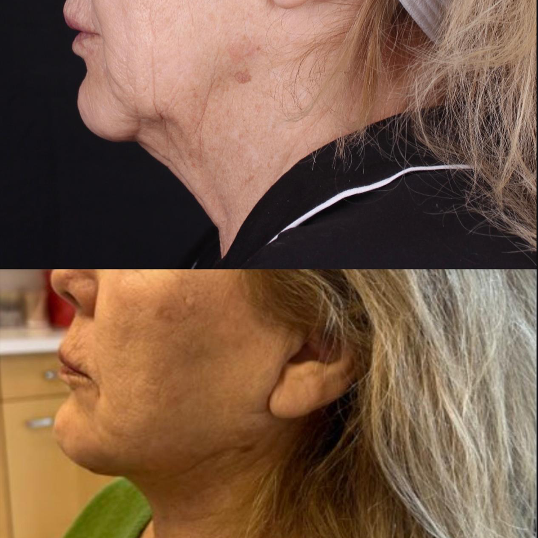 Real patient results before and after plastic surgery results in Beverly Hills, CA, performed by Dr. Moy