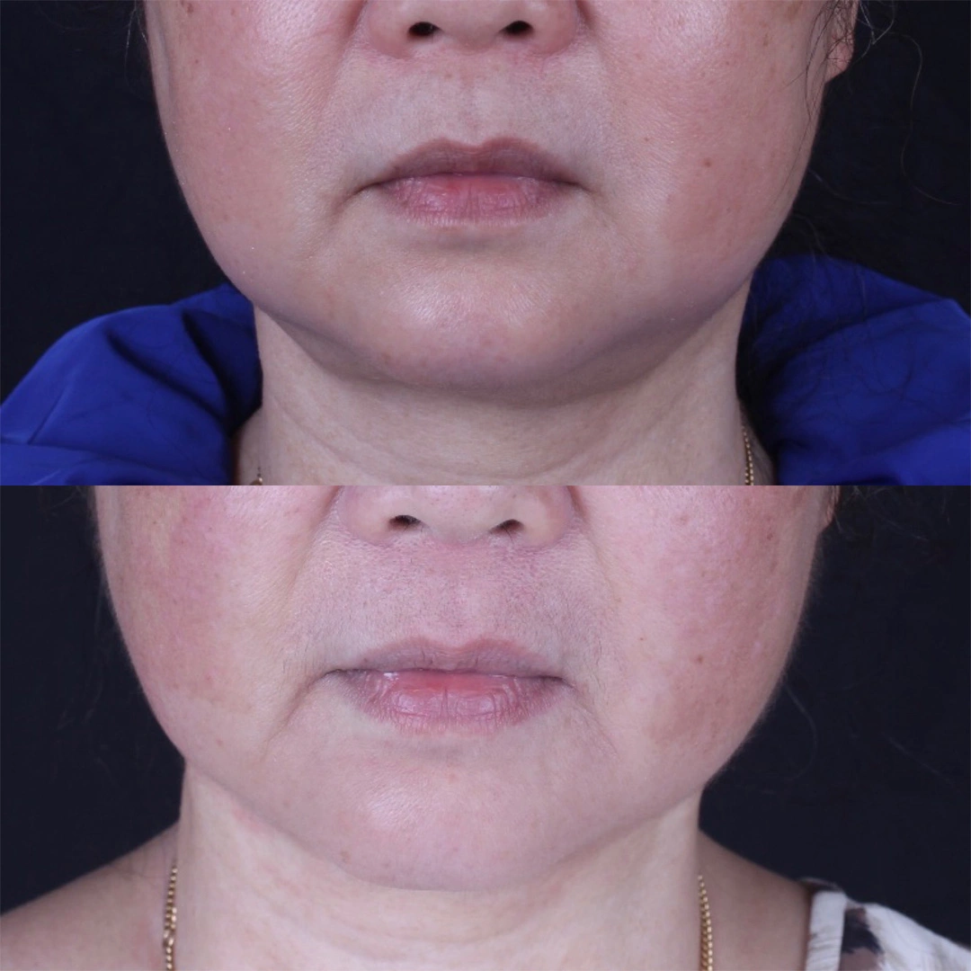 Real patient results before and after plastic surgery results in Beverly Hills, CA, performed by Dr. Moy