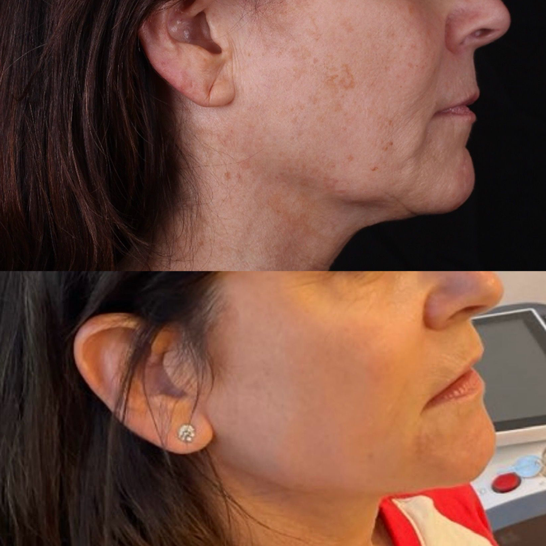 Real patient results before and after plastic surgery results in Beverly Hills, CA, performed by Dr. Moy
