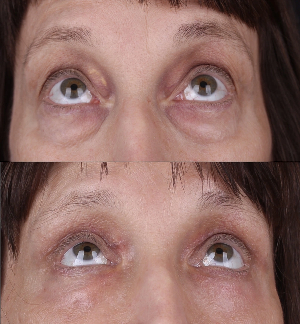 Real patient results before and after plastic surgery results in Beverly Hills, CA, performed by Dr. Moy