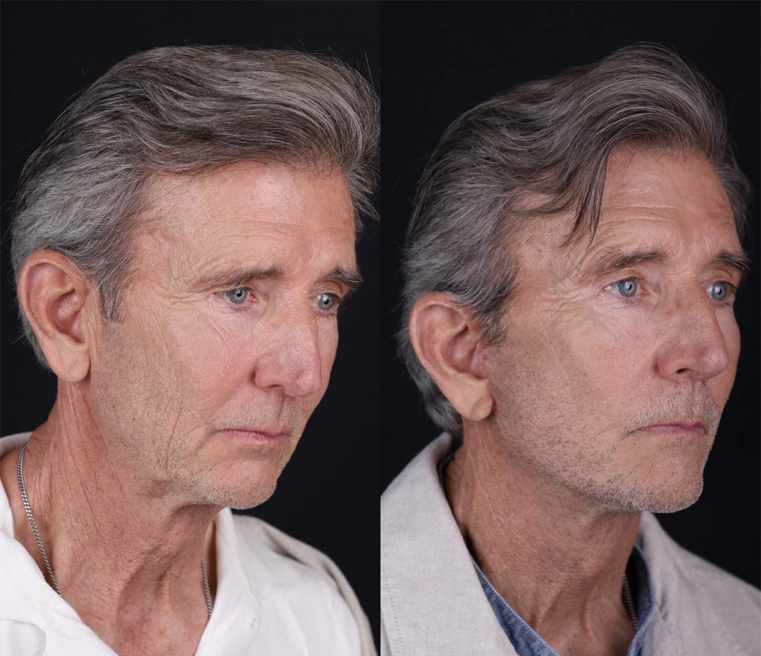 Real patient results before and after plastic surgery results in Beverly Hills, CA, performed by Dr. Moy