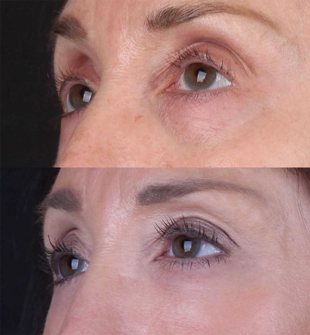 Real patient results before and after plastic surgery results in Beverly Hills, CA, performed by Dr. Moy
