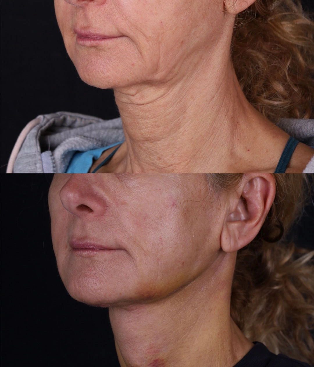 Real patient results before and after plastic surgery results in Beverly Hills, CA, performed by Dr. Moy