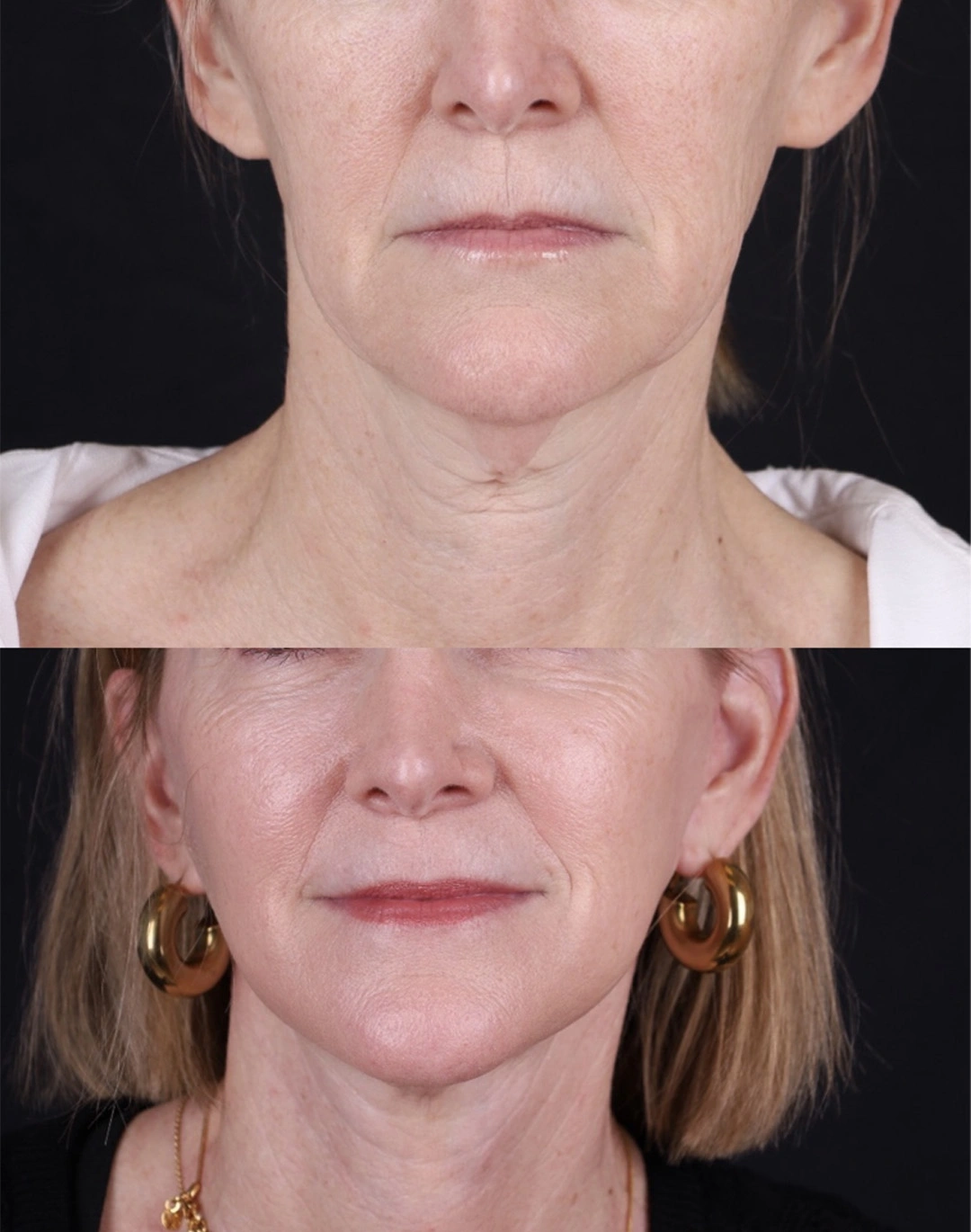 Real patient results before and after plastic surgery results in Beverly Hills, CA, performed by Dr. Moy