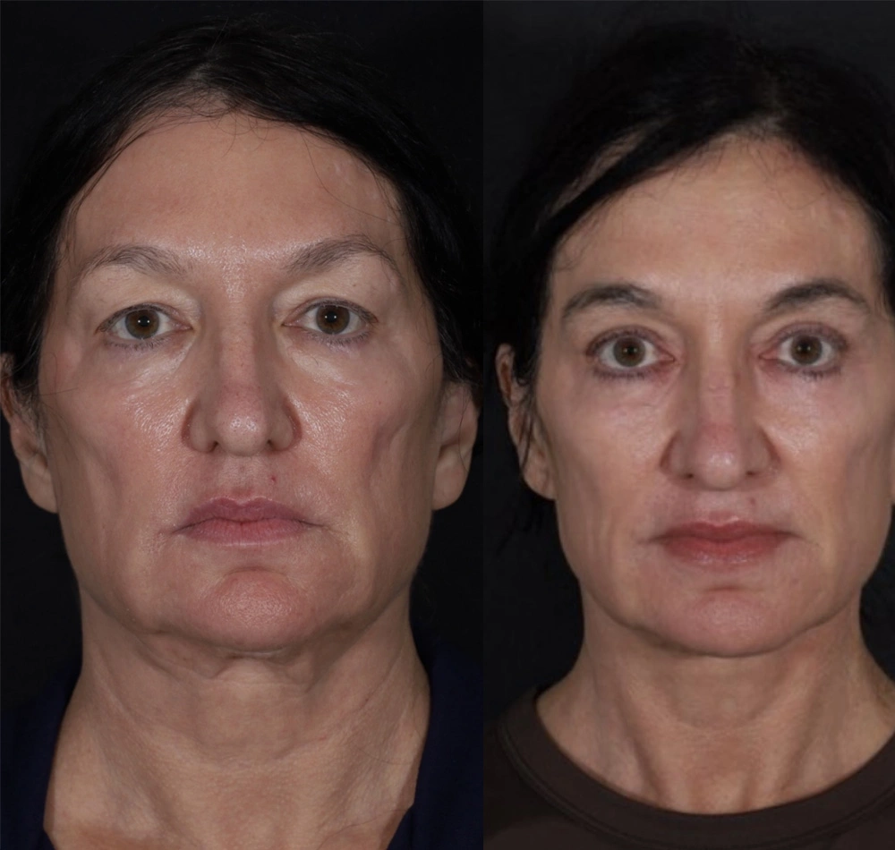 Real patient results before and after plastic surgery results in Beverly Hills, CA, performed by Dr. Moy