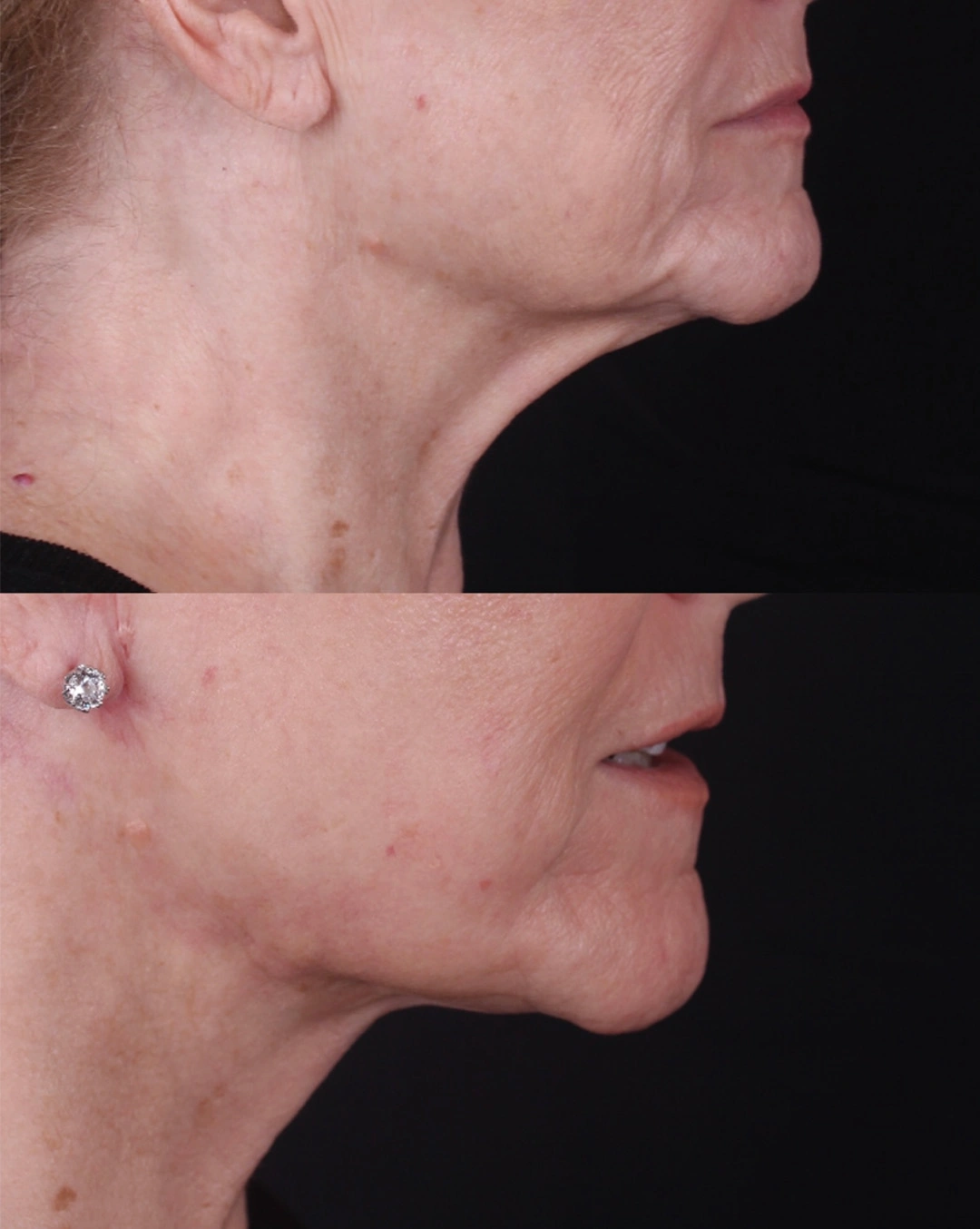 Real patient results before and after plastic surgery results in Beverly Hills, CA, performed by Dr. Moy