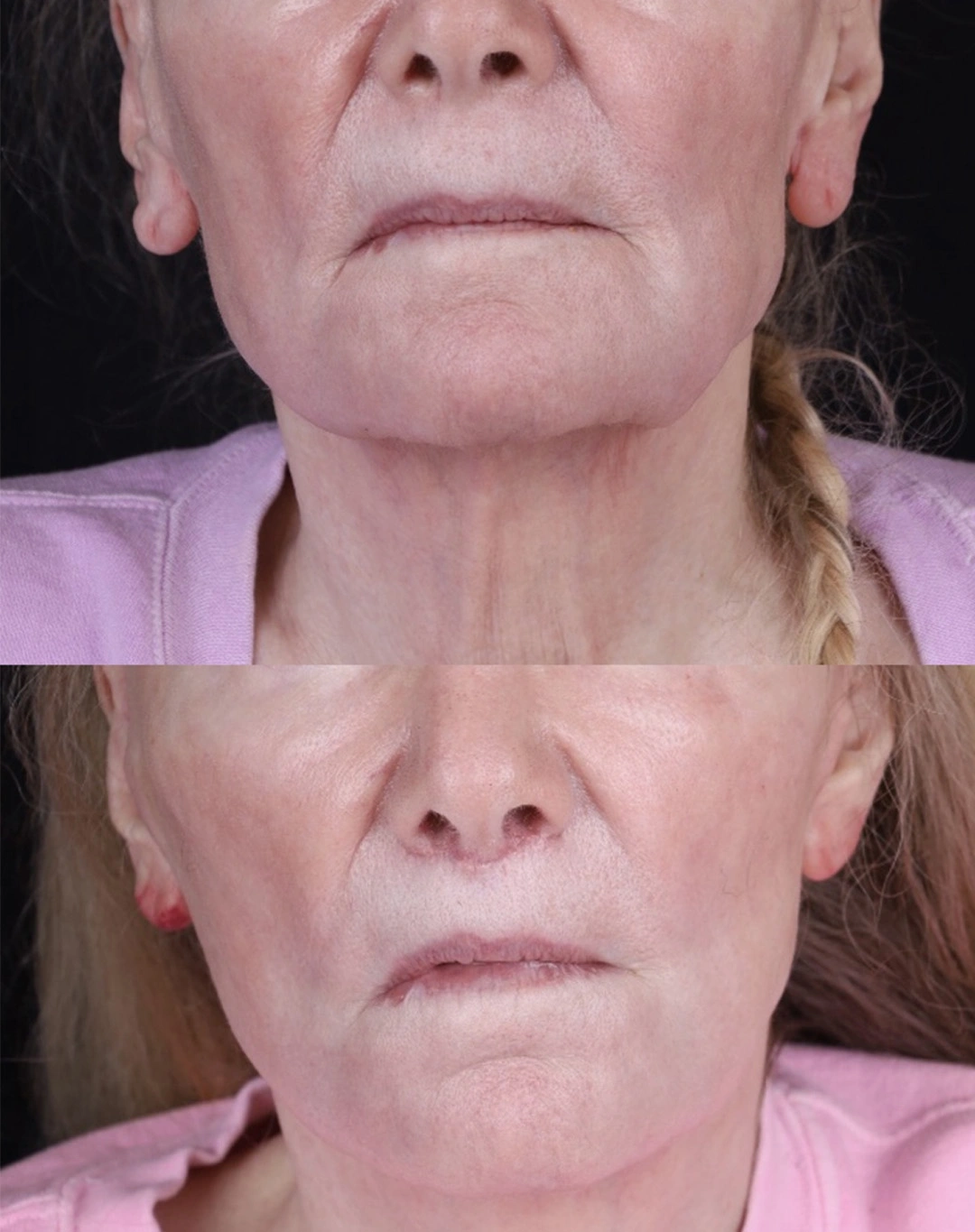 Real patient results before and after plastic surgery results in Beverly Hills, CA, performed by Dr. Moy