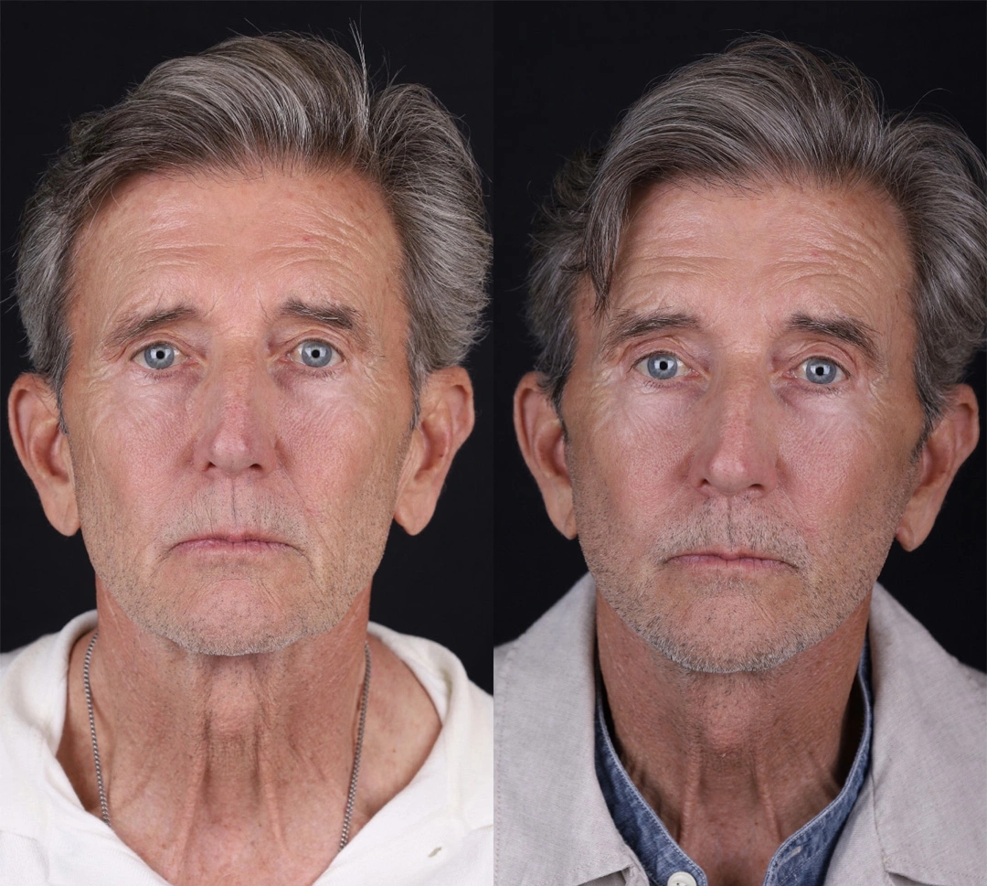 Real patient results before and after plastic surgery results in Beverly Hills, CA, performed by Dr. Moy