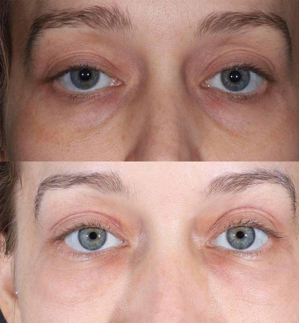 Real patient results before and after plastic surgery results in Beverly Hills, CA, performed by Dr. Moy