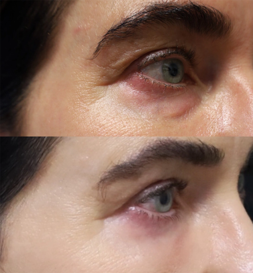 Real patient results before and after plastic surgery results in Beverly Hills, CA, performed by Dr. Moy