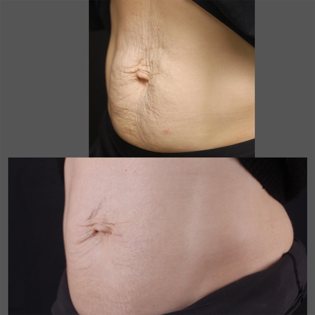 Real patient results before and after plastic surgery results in Beverly Hills, CA, performed by Dr. Moy