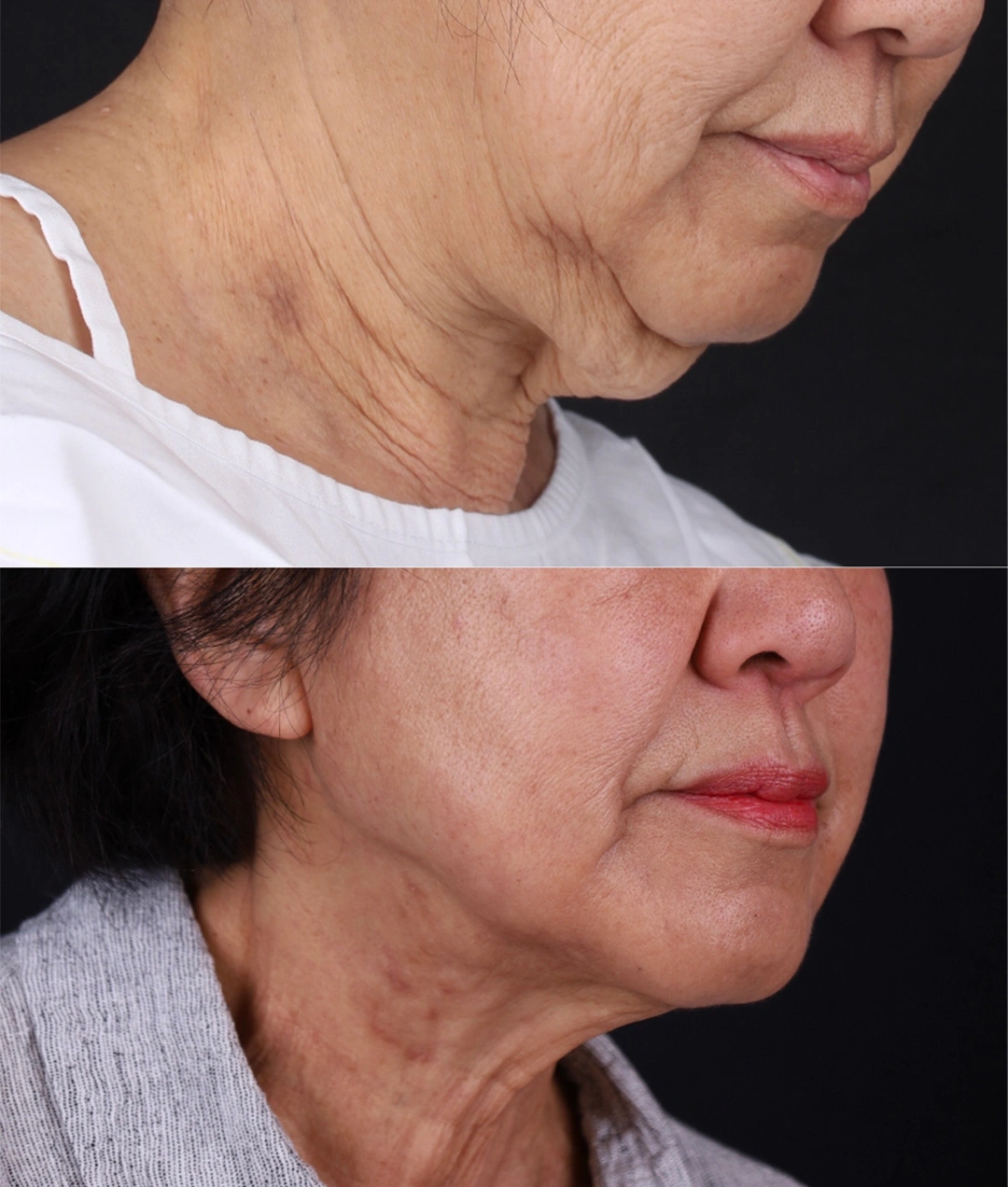 Real patient results before and after plastic surgery results in Beverly Hills, CA, performed by Dr. Moy
