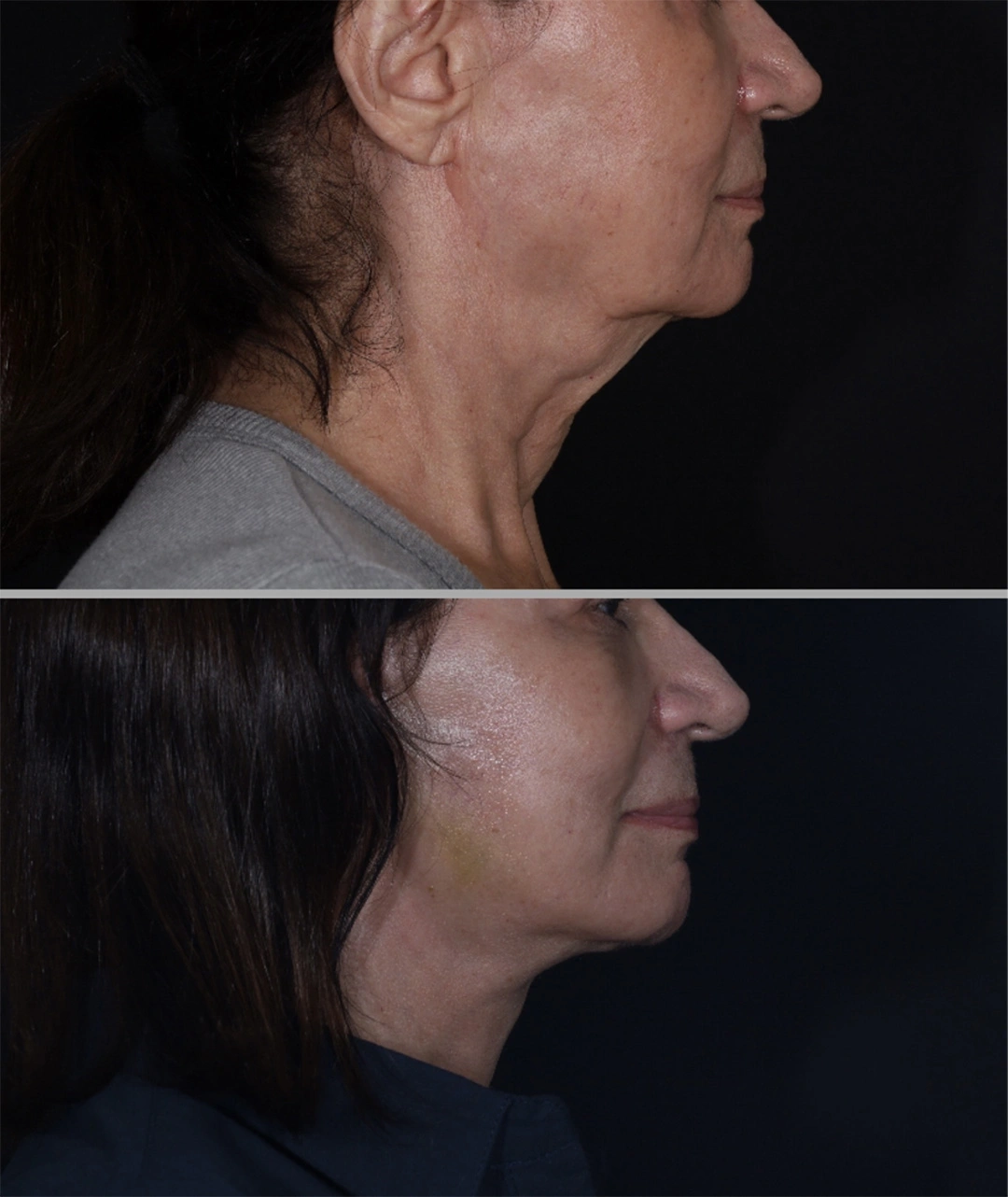 Real patient results before and after plastic surgery results in Beverly Hills, CA, performed by Dr. Moy