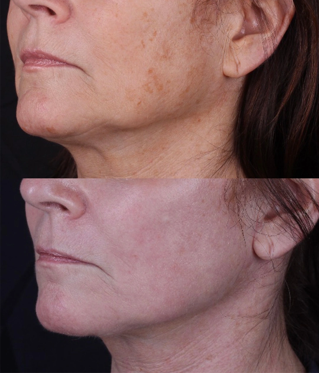 Real patient results before and after plastic surgery results in Beverly Hills, CA, performed by Dr. Moy