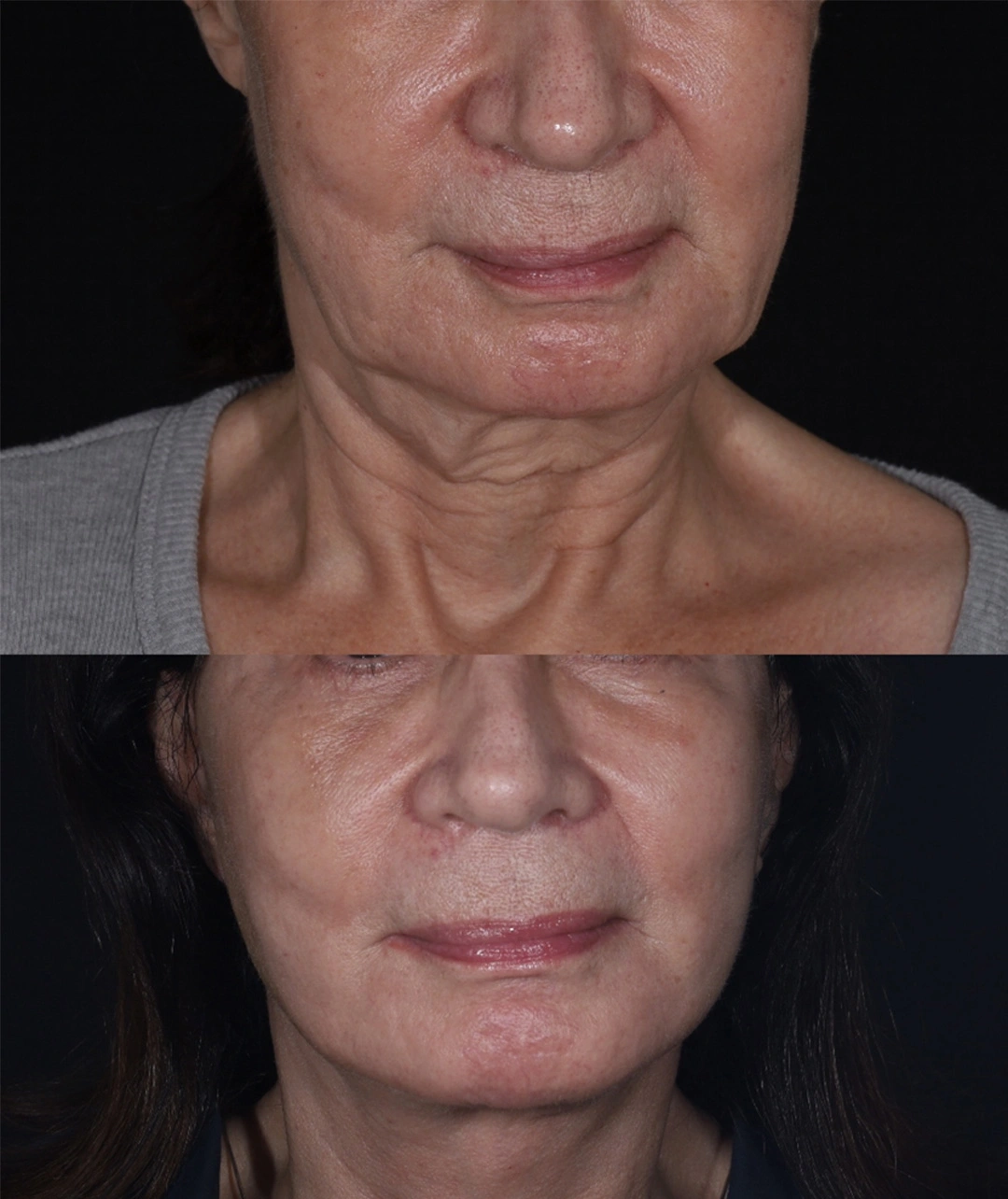 Real patient results before and after plastic surgery results in Beverly Hills, CA, performed by Dr. Moy