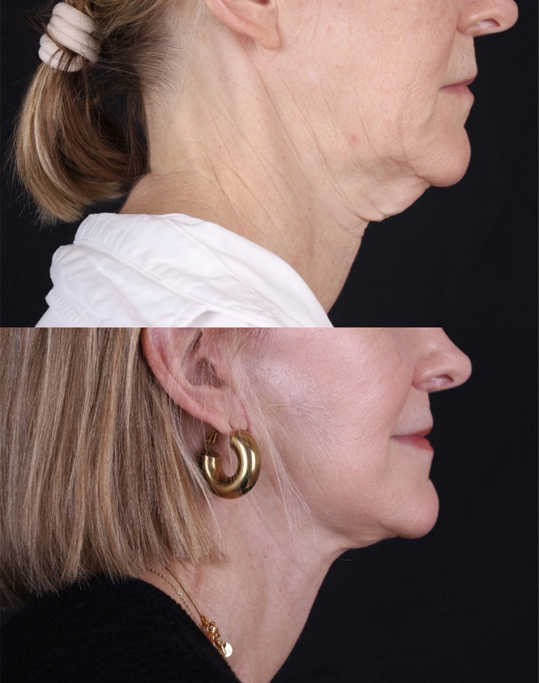 Real patient results before and after plastic surgery results in Beverly Hills, CA, performed by Dr. Moy
