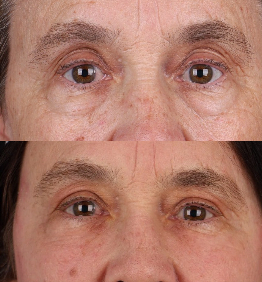 Real patient results before and after plastic surgery results in Beverly Hills, CA, performed by Dr. Moy