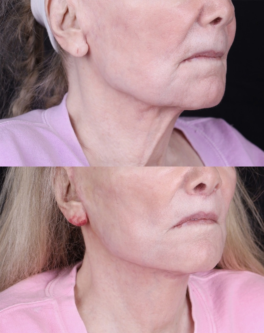 Real patient results before and after plastic surgery results in Beverly Hills, CA, performed by Dr. Moy