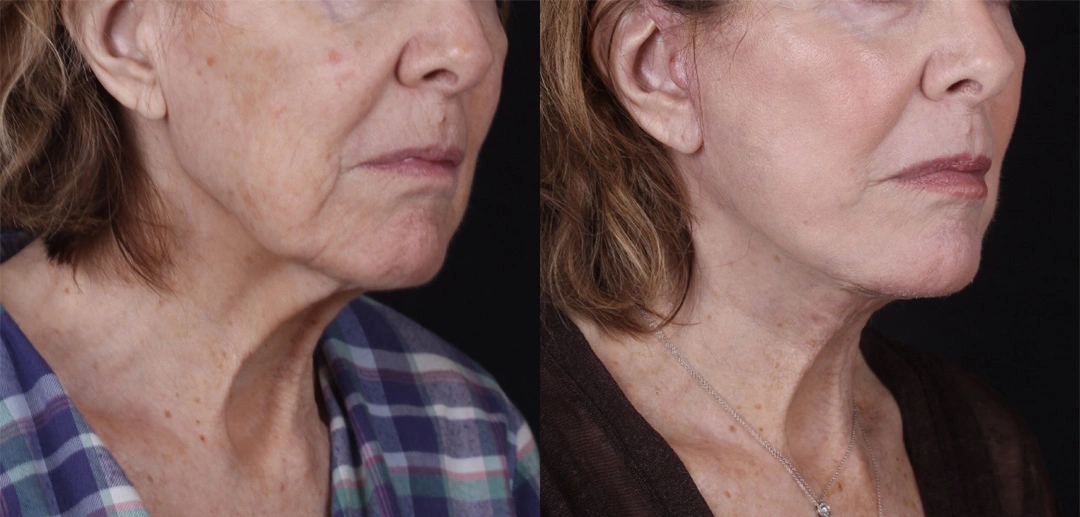 Real patient results before and after plastic surgery results in Beverly Hills, CA, performed by Dr. Moy
