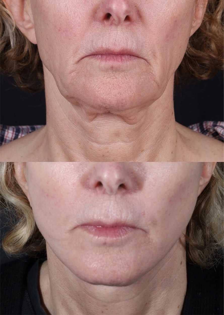 Real patient results before and after plastic surgery results in Beverly Hills, CA, performed by Dr. Moy