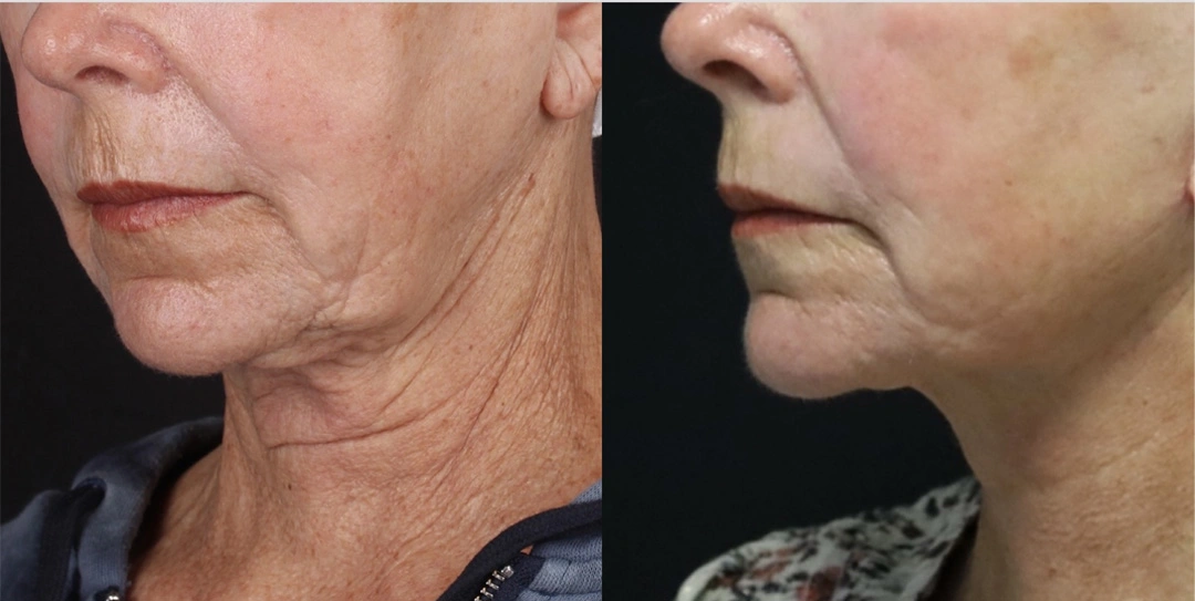 Real patient results before and after plastic surgery results in Beverly Hills, CA, performed by Dr. Moy