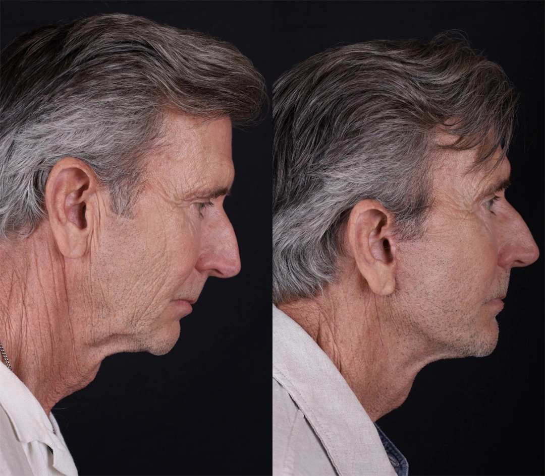 Real patient results before and after plastic surgery results in Beverly Hills, CA, performed by Dr. Moy