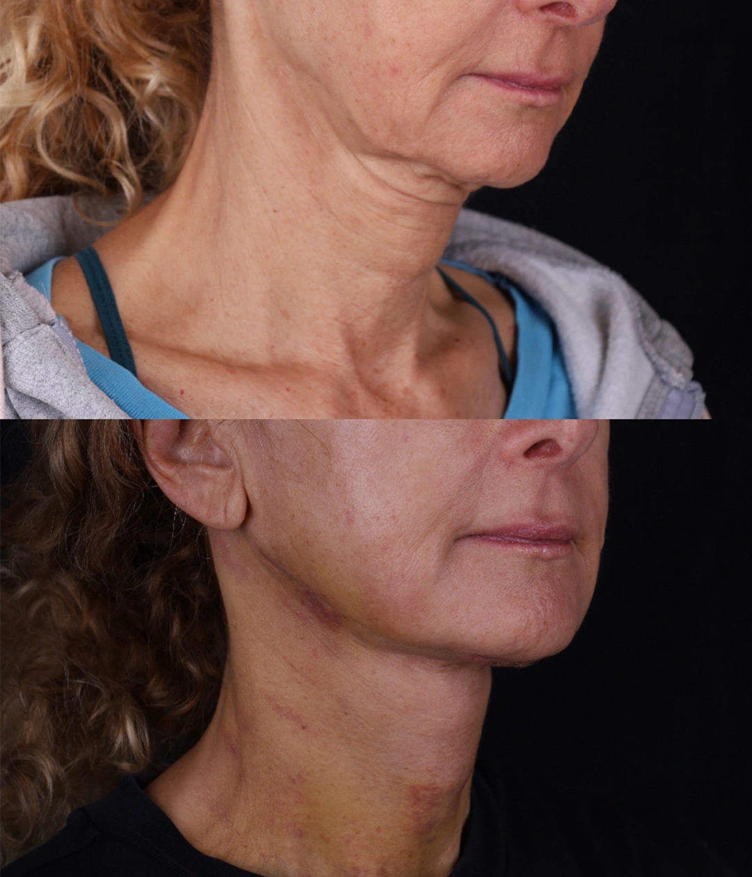 Real patient results before and after plastic surgery results in Beverly Hills, CA, performed by Dr. Moy