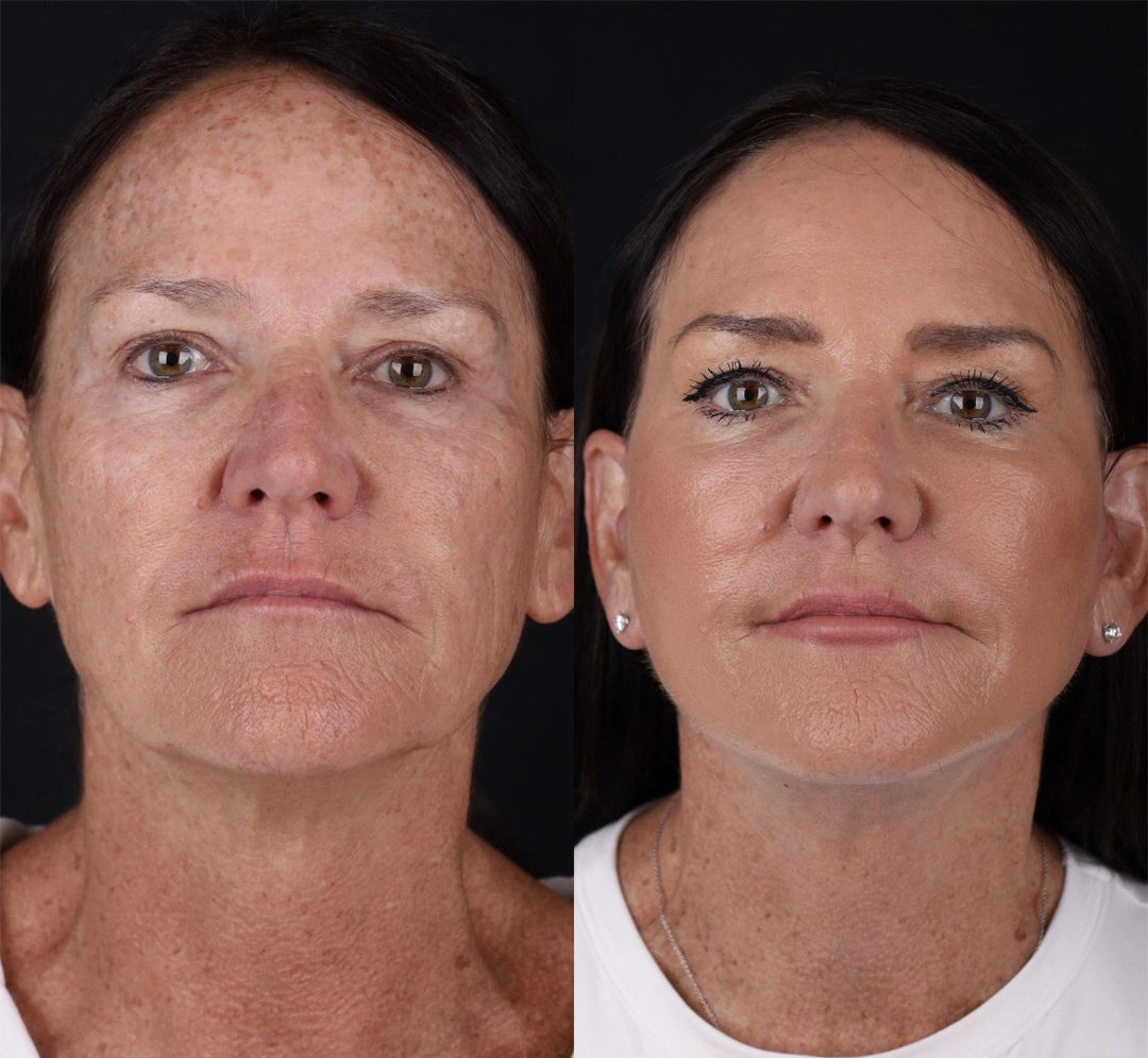 Real patient results before and after plastic surgery results in Beverly Hills, CA, performed by Dr. Moy