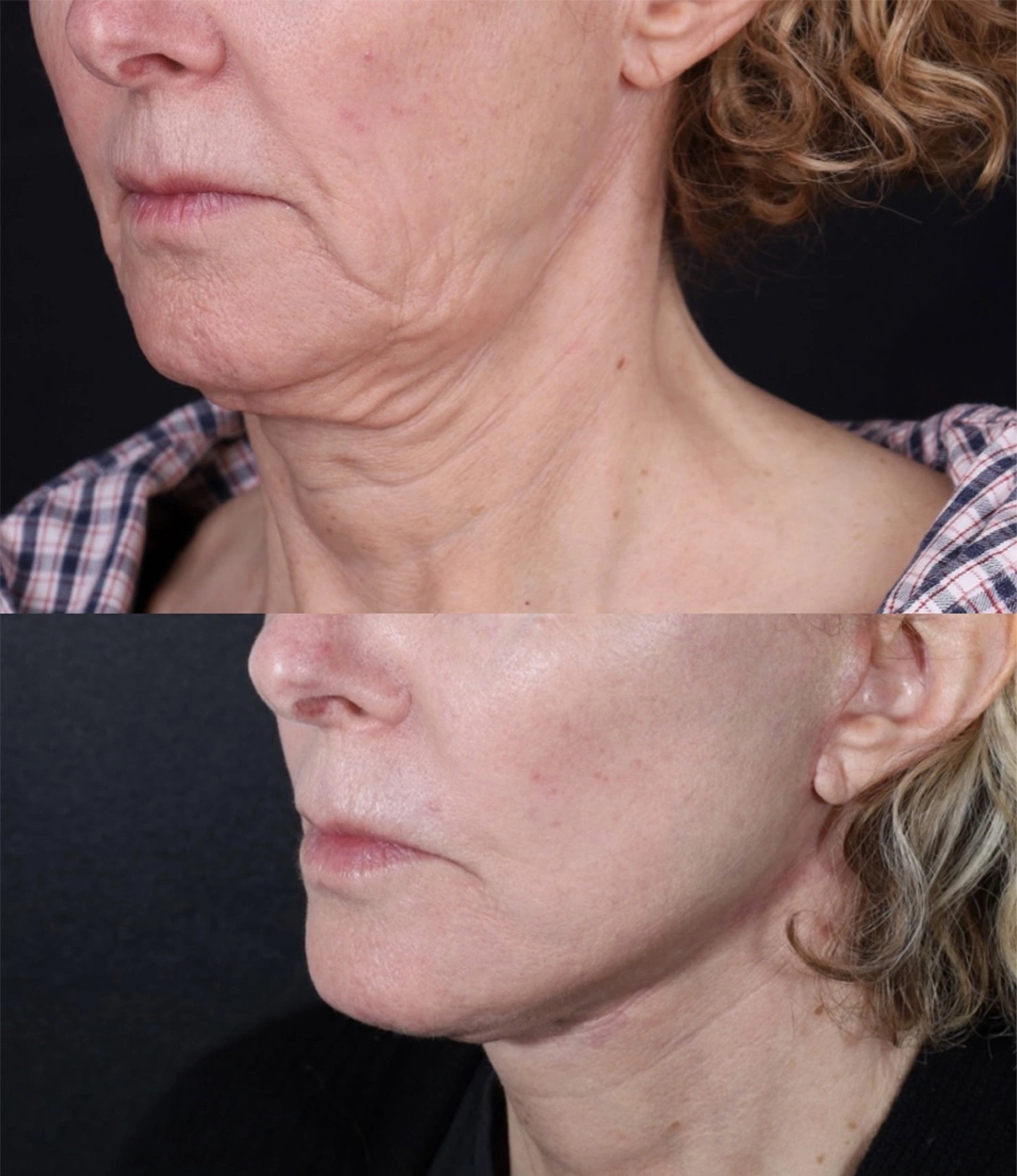 Real patient results before and after plastic surgery results in Beverly Hills, CA, performed by Dr. Moy