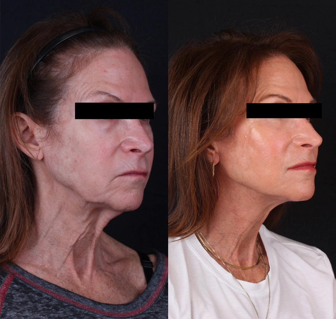 Real patient results before and after plastic surgery results in Beverly Hills, CA, performed by Dr. Moy