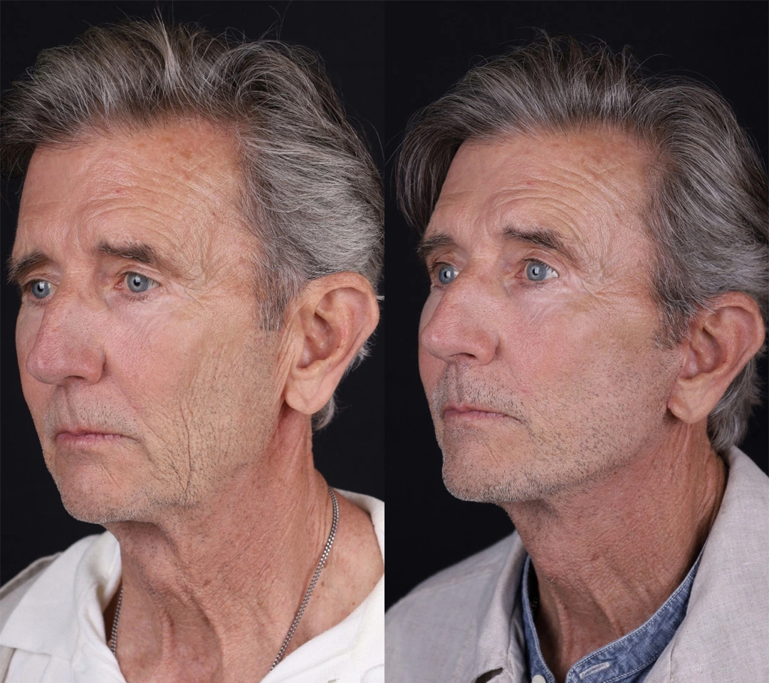 Real patient results before and after plastic surgery results in Beverly Hills, CA, performed by Dr. Moy
