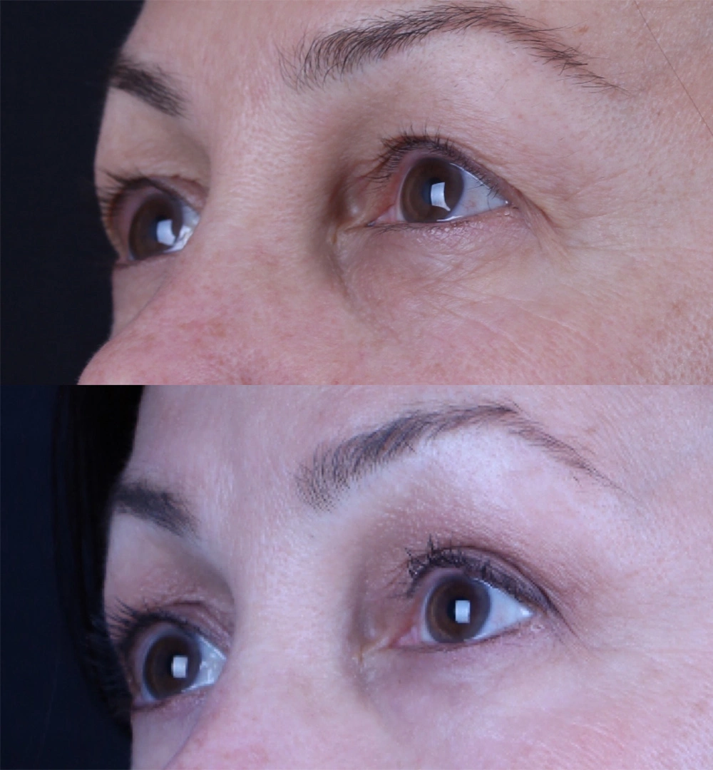 Real patient results before and after plastic surgery results in Beverly Hills, CA, performed by Dr. Moy