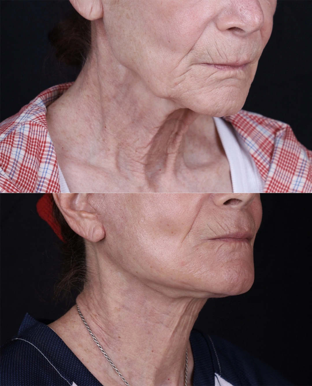 Real patient results before and after plastic surgery results in Beverly Hills, CA, performed by Dr. Moy