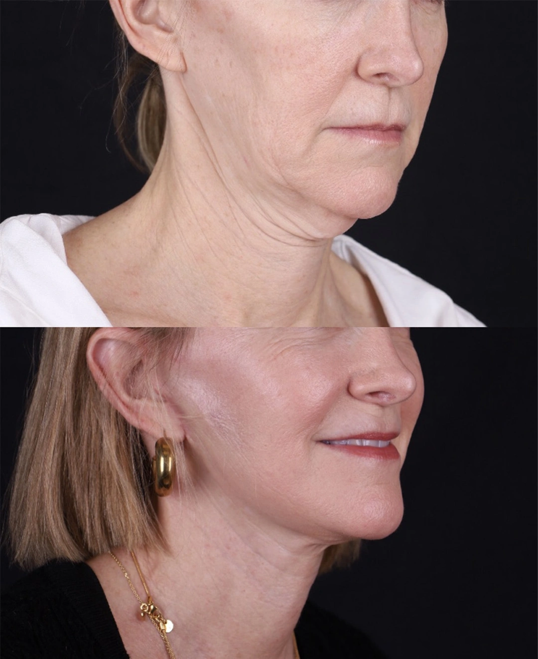 Real patient results before and after plastic surgery results in Beverly Hills, CA, performed by Dr. Moy