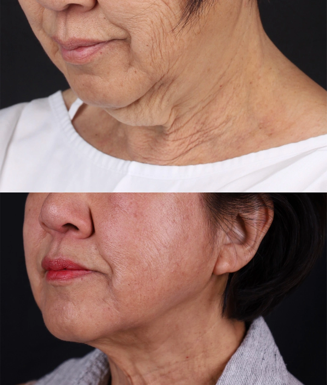 Real patient results before and after plastic surgery results in Beverly Hills, CA, performed by Dr. Moy