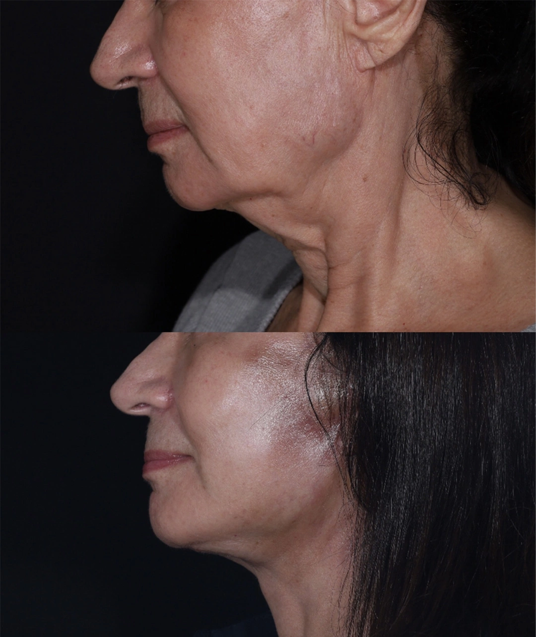 Real patient results before and after plastic surgery results in Beverly Hills, CA, performed by Dr. Moy