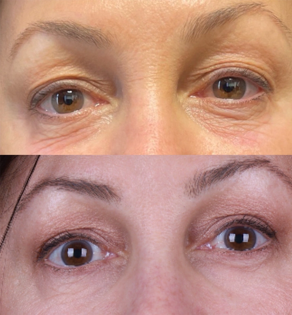 Real patient results before and after plastic surgery results in Beverly Hills, CA, performed by Dr. Moy