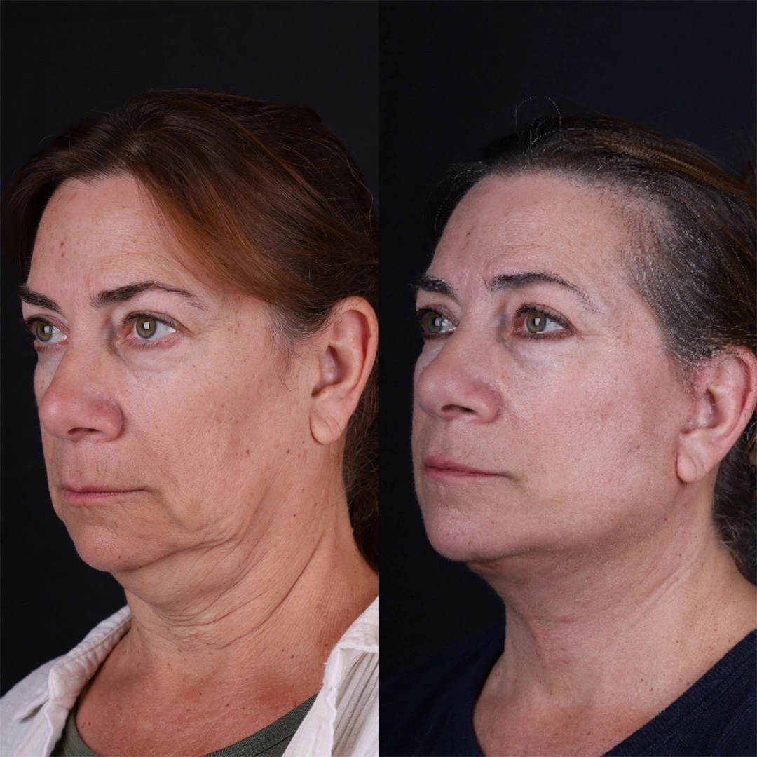 Real patient results before and after plastic surgery results in Beverly Hills, CA, performed by Dr. Moy