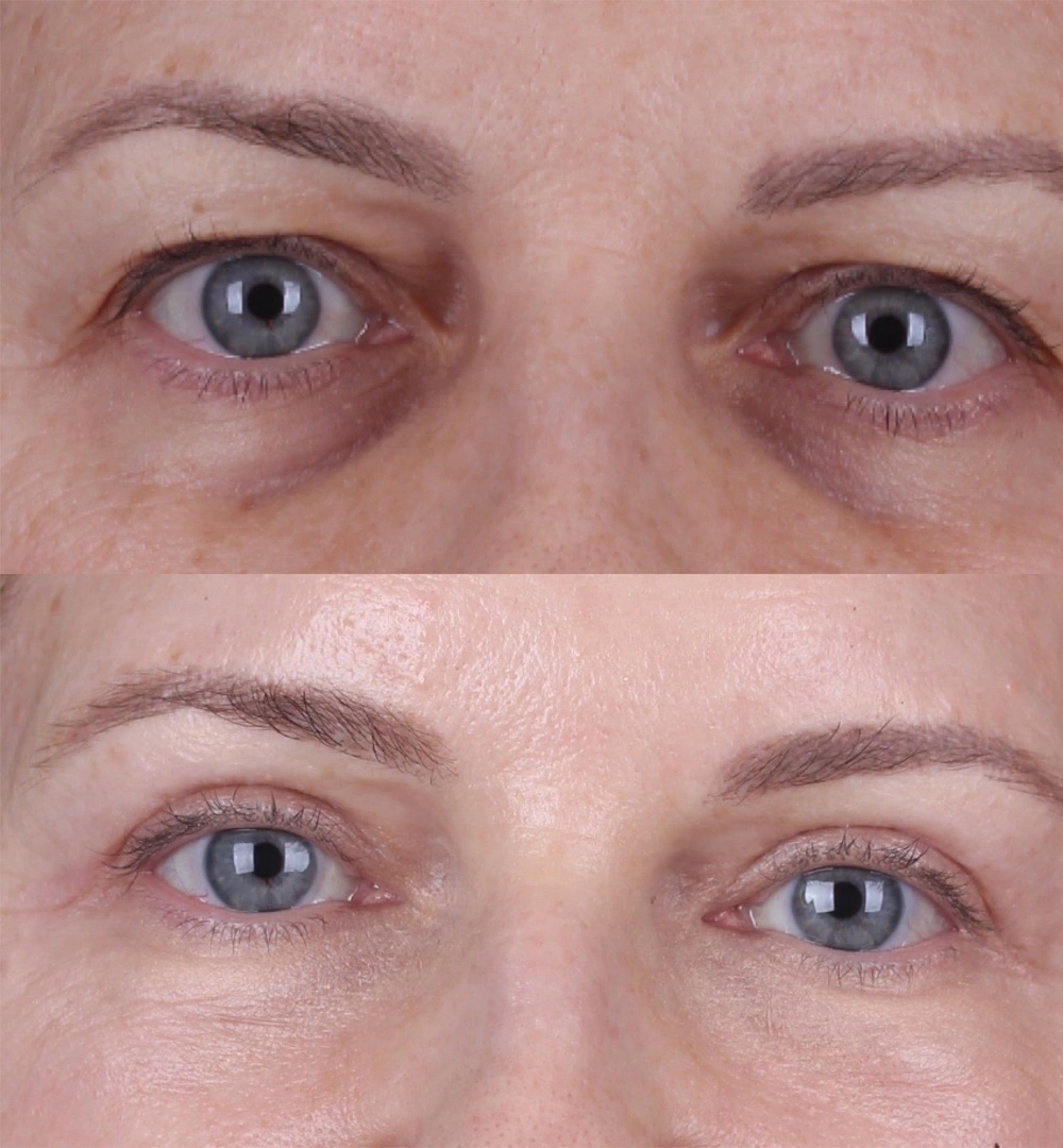 Real patient results before and after plastic surgery results in Beverly Hills, CA, performed by Dr. Moy