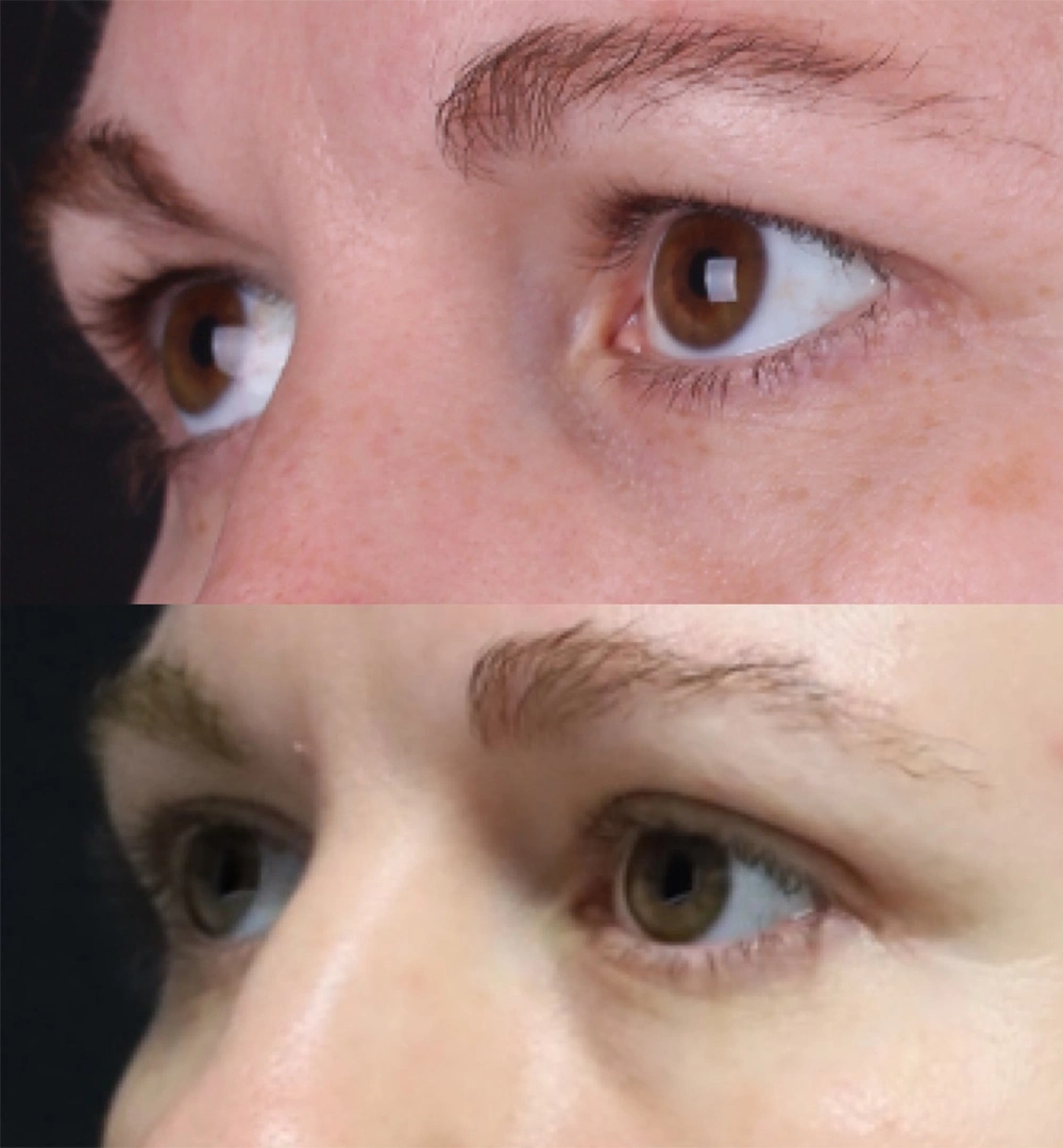 Real patient results before and after plastic surgery results in Beverly Hills, CA, performed by Dr. Moy