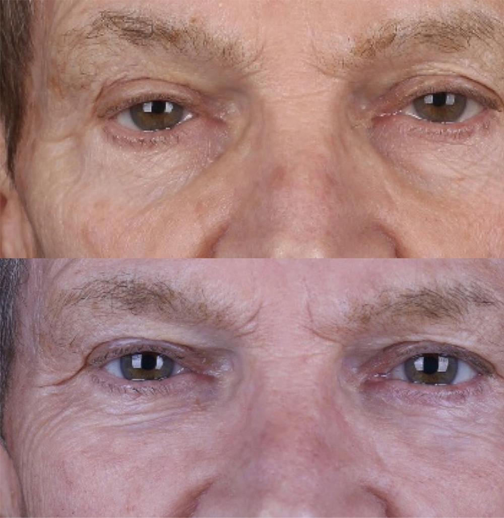 Real patient results before and after plastic surgery results in Beverly Hills, CA, performed by Dr. Moy