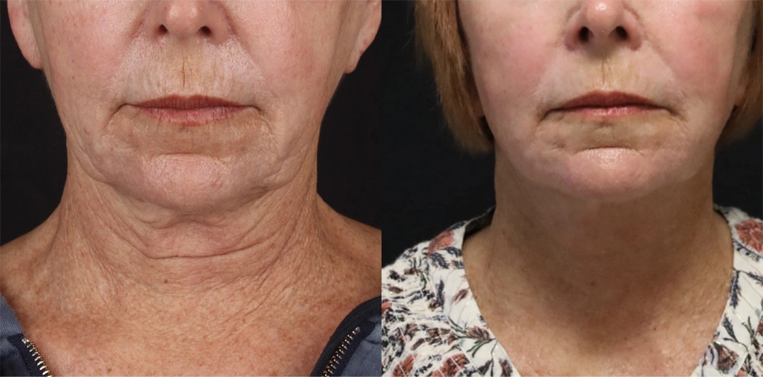 Real patient results before and after plastic surgery results in Beverly Hills, CA, performed by Dr. Moy