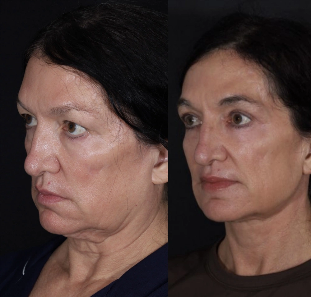 Real patient results before and after plastic surgery results in Beverly Hills, CA, performed by Dr. Moy