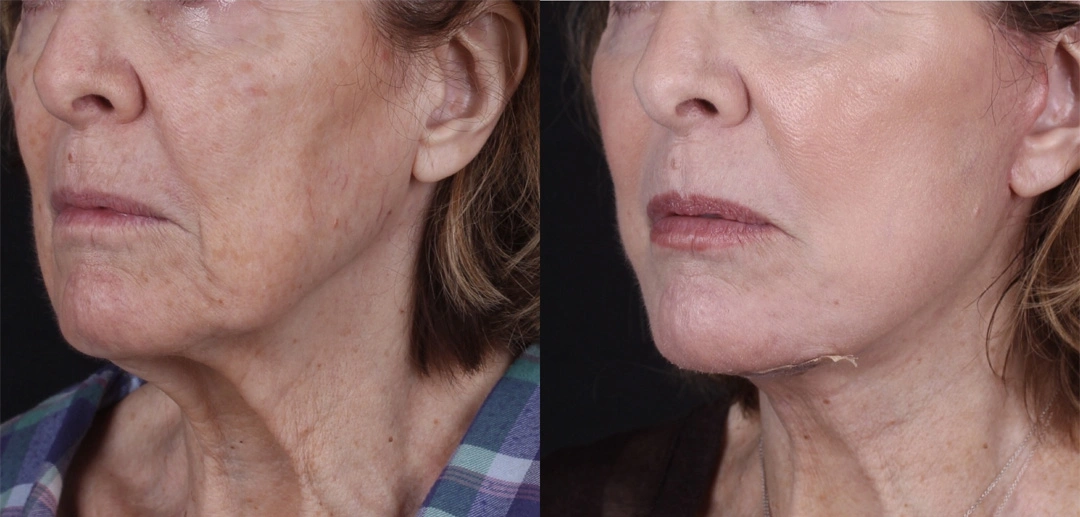 Real patient results before and after plastic surgery results in Beverly Hills, CA, performed by Dr. Moy