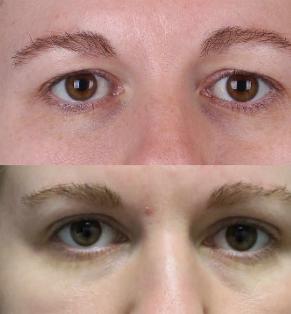 Real patient results before and after plastic surgery results in Beverly Hills, CA, performed by Dr. Moy