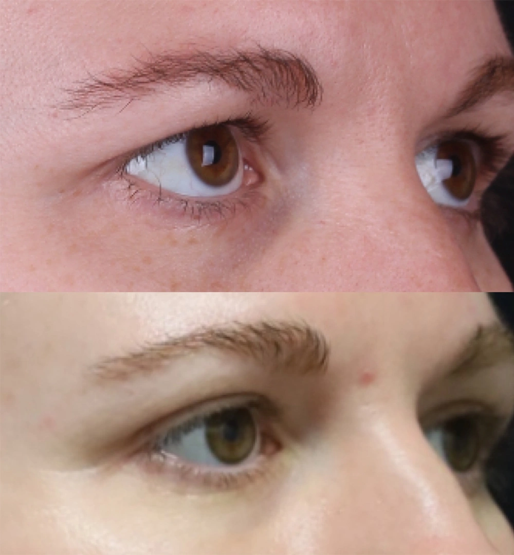 Real patient results before and after plastic surgery results in Beverly Hills, CA, performed by Dr. Moy