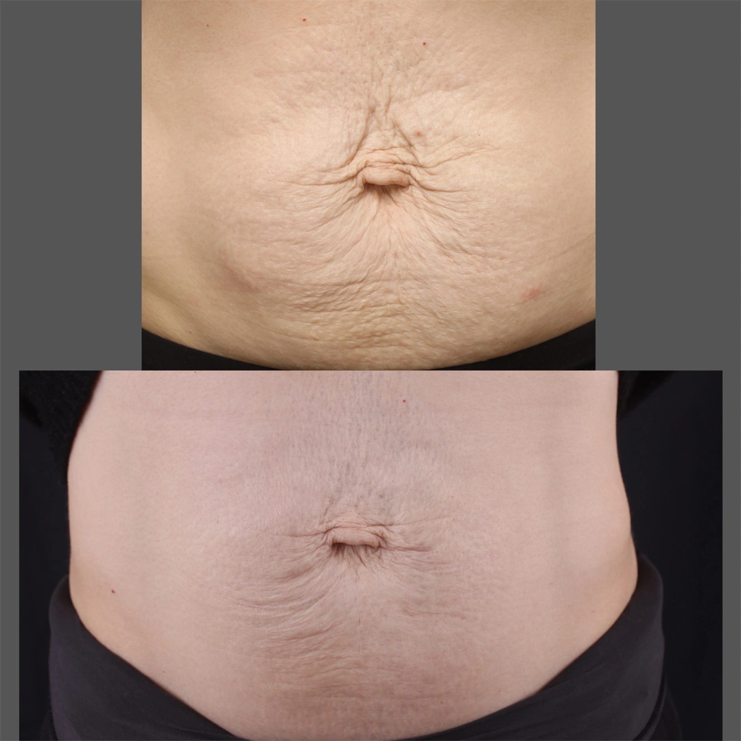 Real patient results before and after plastic surgery results in Beverly Hills, CA, performed by Dr. Moy