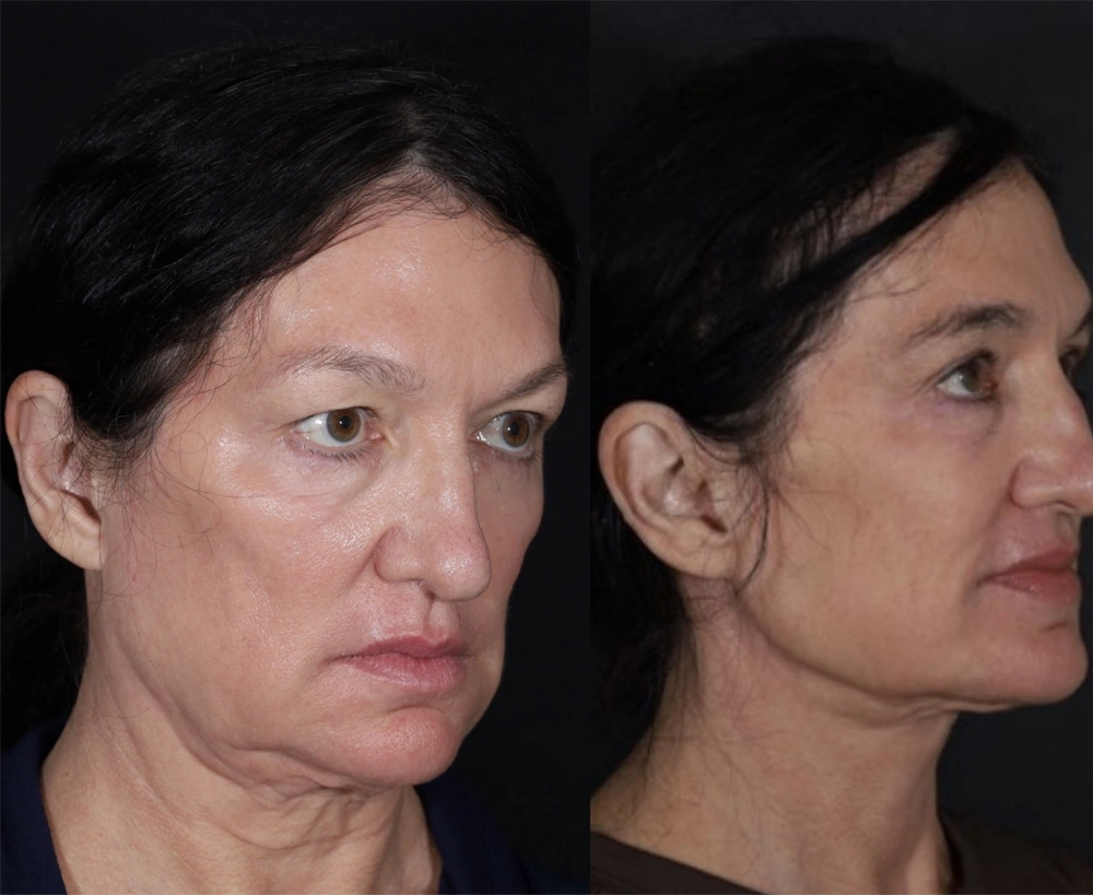 Real patient results before and after plastic surgery results in Beverly Hills, CA, performed by Dr. Moy