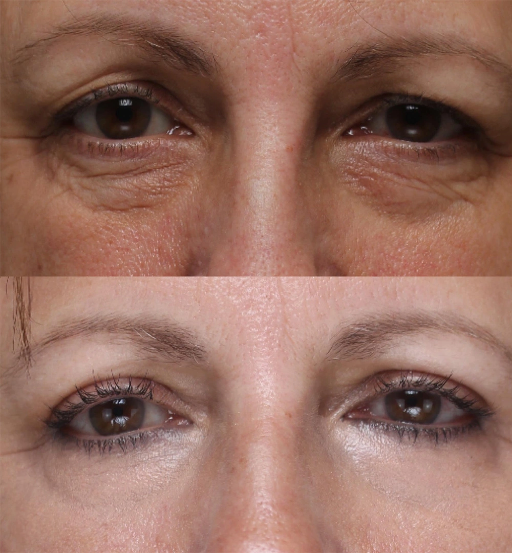 Real patient results before and after plastic surgery results in Beverly Hills, CA, performed by Dr. Moy