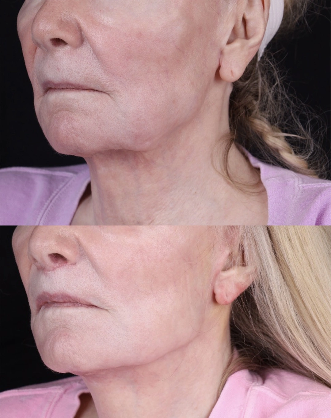 Real patient results before and after plastic surgery results in Beverly Hills, CA, performed by Dr. Moy